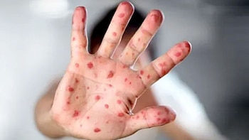 The MPOX is known as