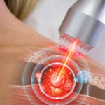 Scientists Develop Microneedles to Enhance Light Penetration and Target Tough Skin Cancer