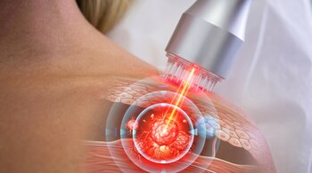 Scientists Develop Microneedles to Enhance Light Penetration and Target Tough Skin Cancer
