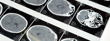 Science Reveals How the Sauna “Hacks” the Brain: It Reduces Alzheimer’s Risk by 65%