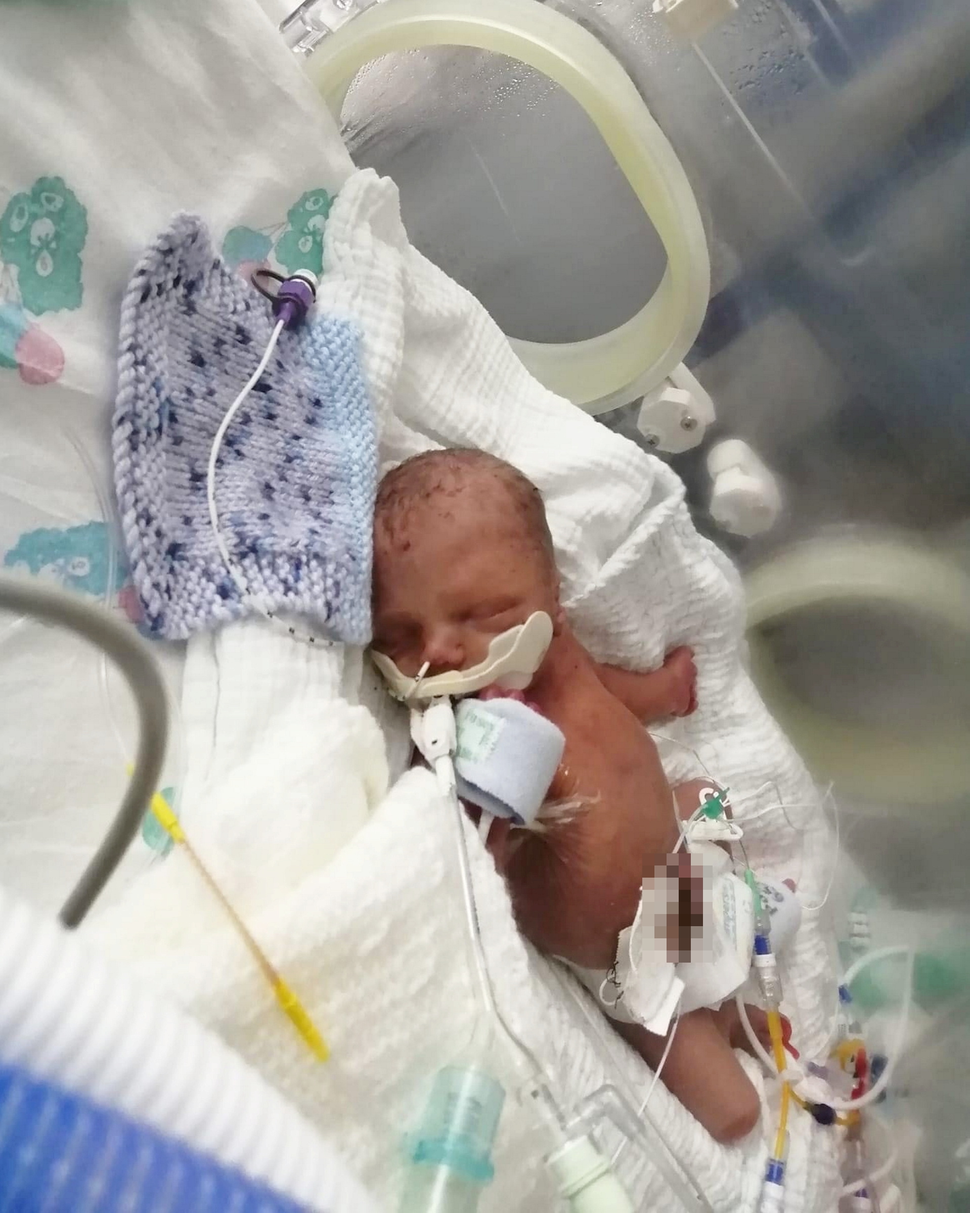 Una semana después, Rebecca fue llevada a otro hospital y Charlie-Jay nació por cesárea de emergencia.