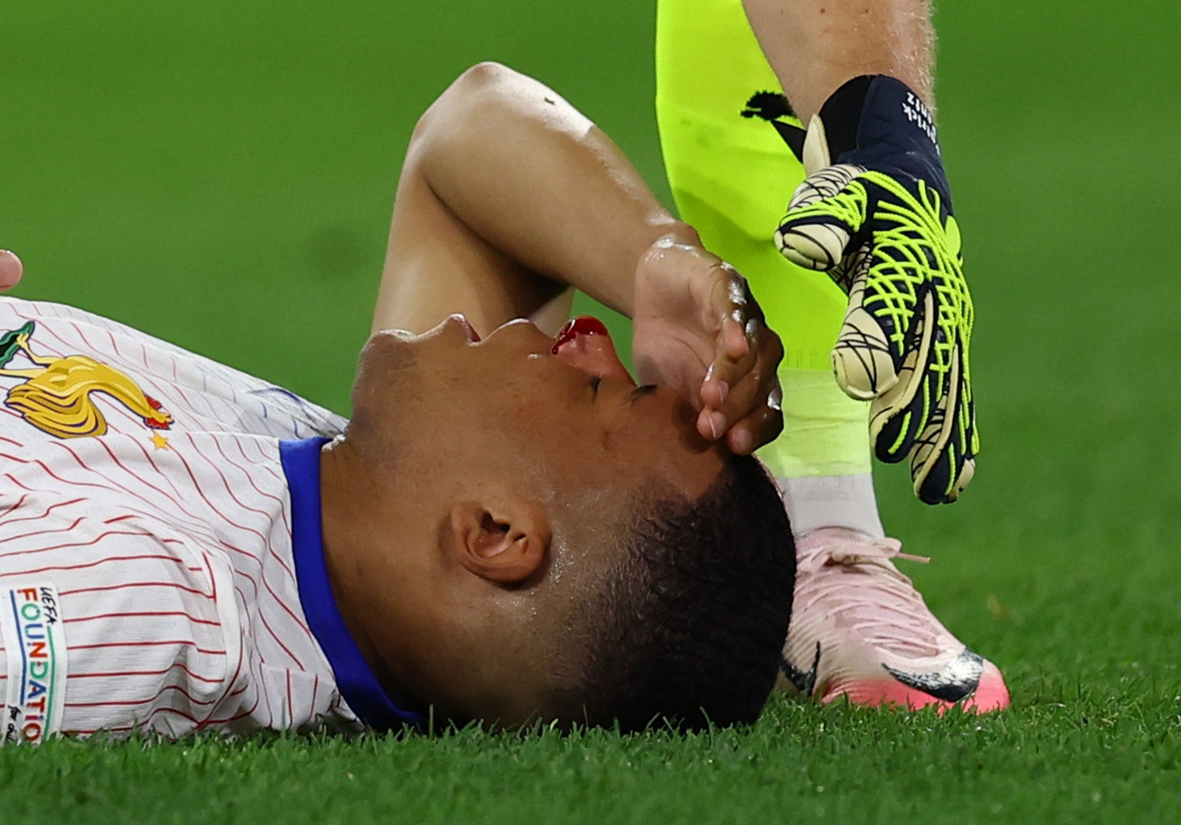 Kylian Mbappé quedó cubierto de sangre tras un choque en el campo contra Austria