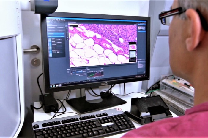 Una persona con gafas mira una pantalla de ordenador que muestra una imagen ampliada de una muestra de un tumor. La pantalla muestra un software de análisis detallado con varias ventanas y una imagen de identificación del contenido del tumor codificada por colores. En el escritorio se ven un teclado y otros equipos de laboratorio.