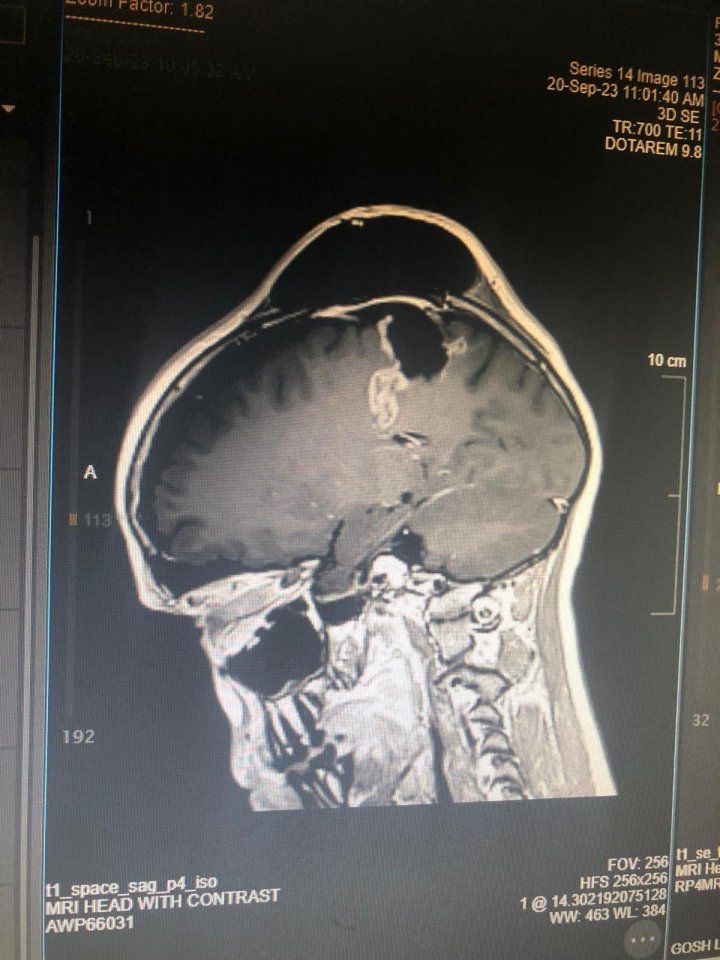 Oscar finalmente se hizo una resonancia magnética que reveló que tenía un tumor cerebral ependimoma de 7 cm.