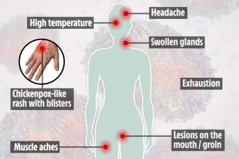 Síntomas clásicos de MPOX