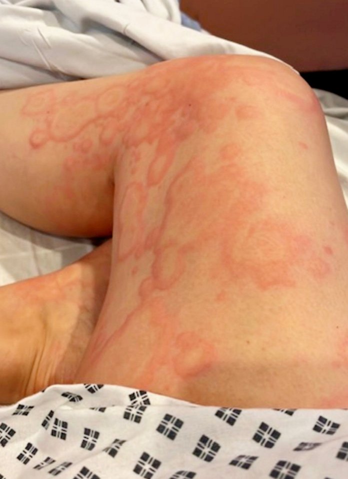 Primer plano de una mano con una erupción severa.