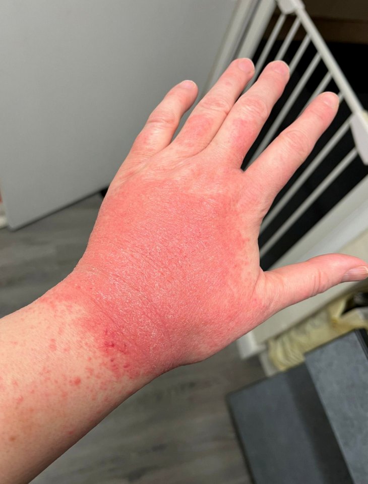 Mano con erupción severa.