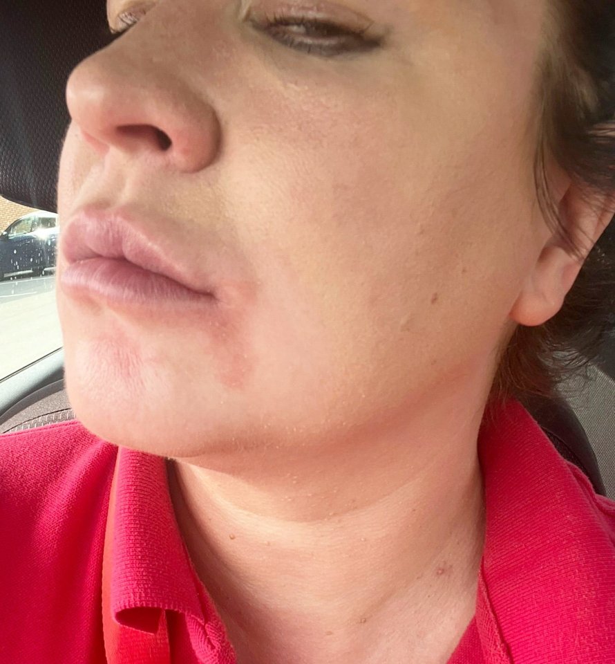 Primer plano de la cara de una mujer que muestra una reacción de la piel.