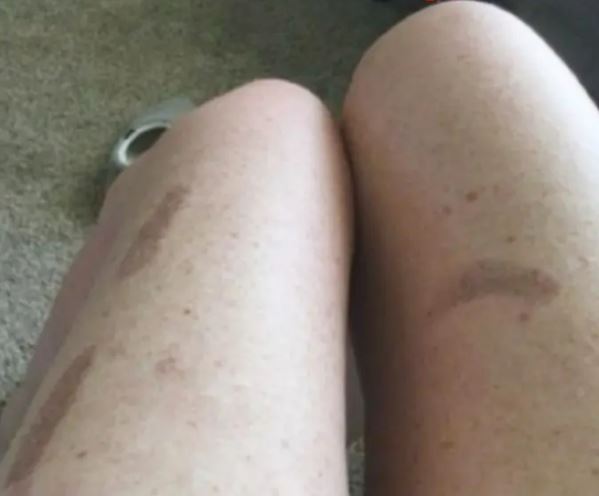 Foto de piernas con grandes contusiones.