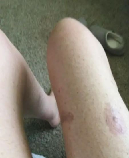Foto de piernas con contusiones y cicatrices.