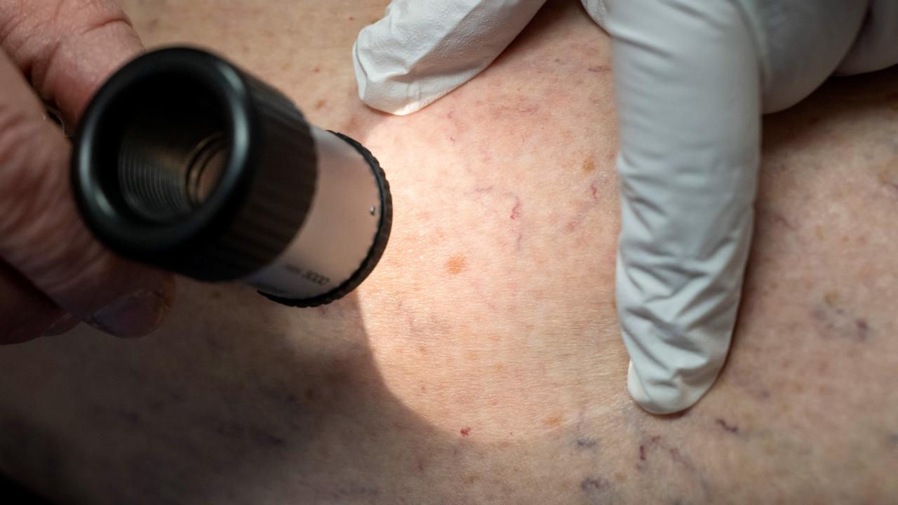 Fuerte aumento en los tratamientos de cáncer de piel