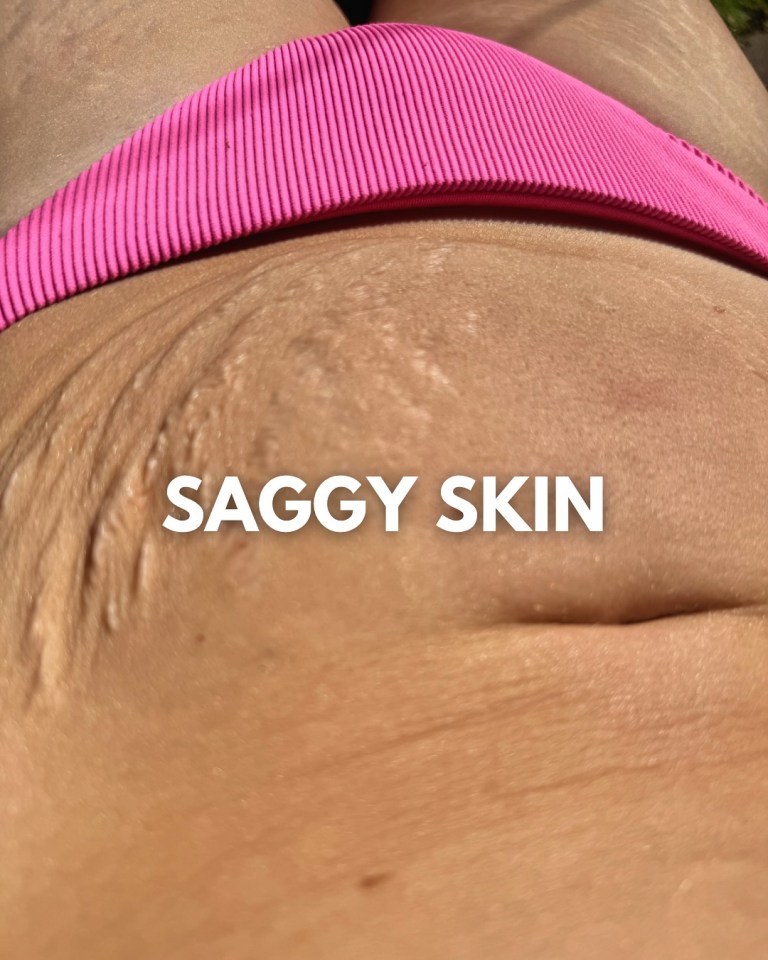 Hundir la piel en el abdomen de una persona.