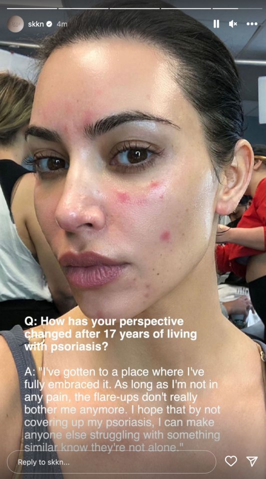 Primer plano de la cara de Kim Kardashian que muestra psoriasis.