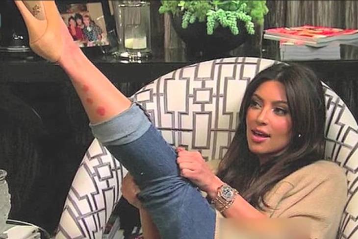 Kim Kardashian mostrando psoriasis en su pierna.