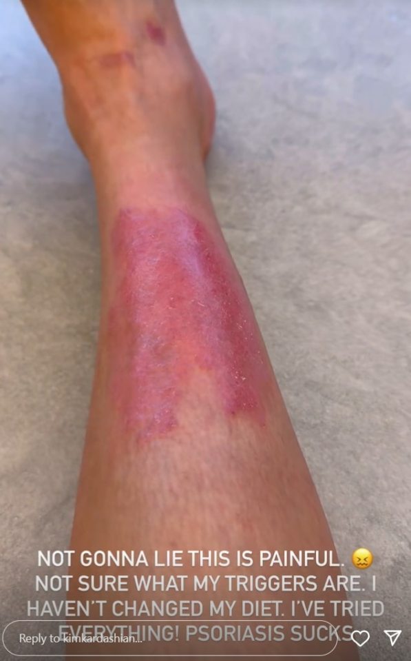 Imagen de una pierna con psoriasis.