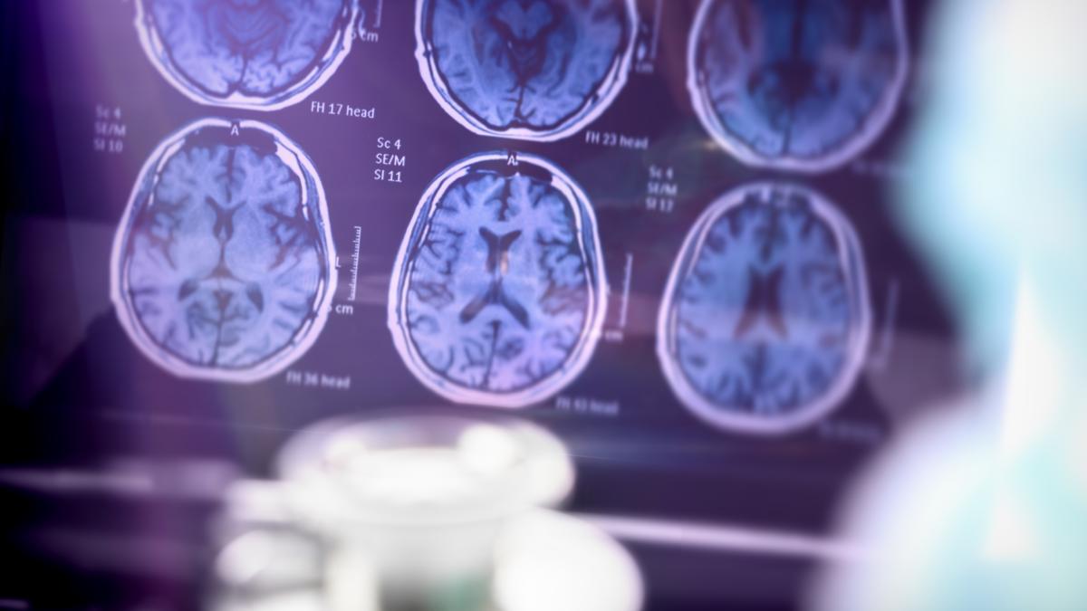 Alzheimer temprano: los síntomas que no deben subestimarse entre los