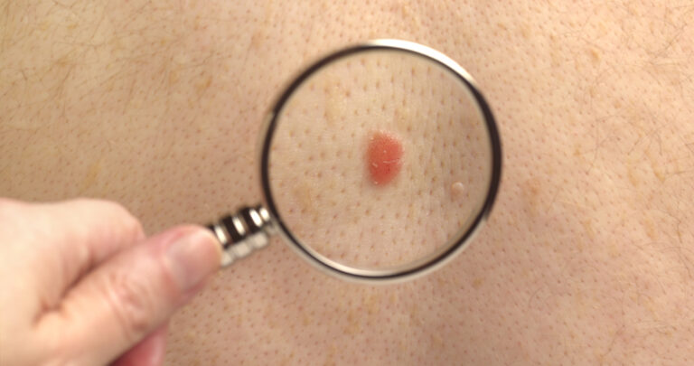 Con motivo del Día del Euromelanoma y el Mes de