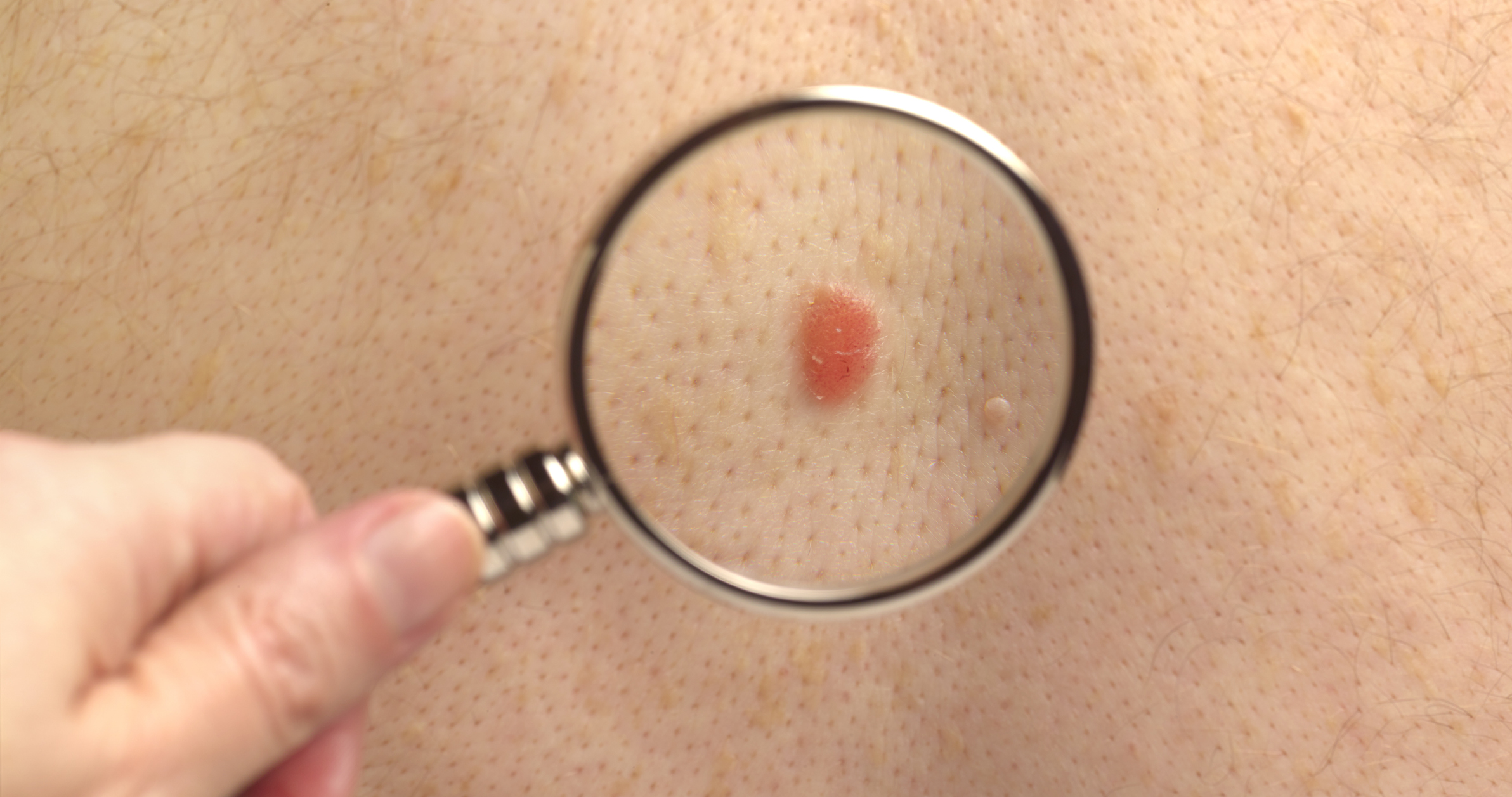Con motivo del Día del Euromelanoma y el Mes de