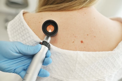 El cáncer de piel afecta a hombres y mujeres en
