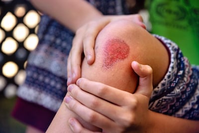 Heridas de personas se curaron más lentamente que las de
