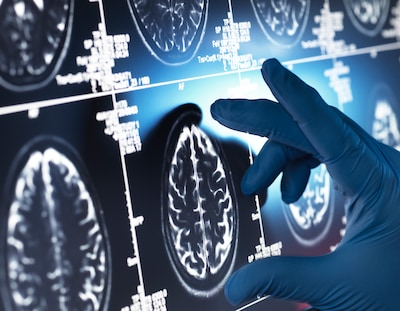 Ku Louven desarrolla un modelo genético para predecir el Alzheimer