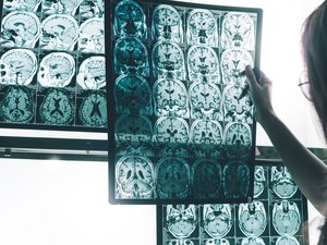 ¿Se puede morir de la enfermedad de Alzheimer?