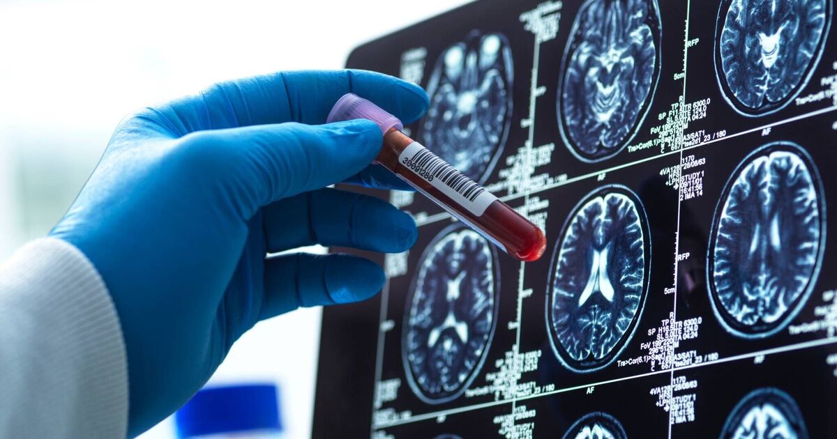 Prueba de sangre innovadora diagnostica Alzheimer en etapas tempranas |