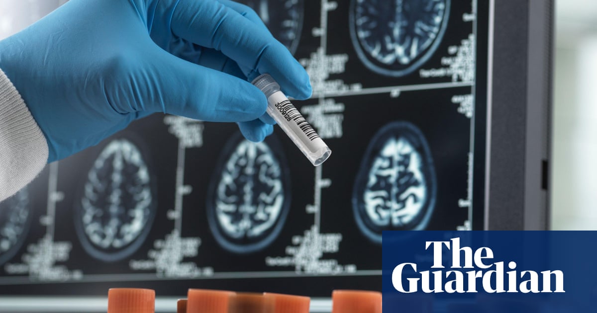 Prueba de sangre para el Alzheimer puede detectar a personas