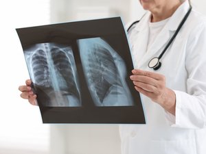 Adenocarcinoma pulmonar: la supervivencia a 3 años se ha duplicado