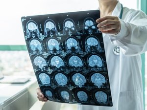 Alzheimer: ¿una deficiencia cerebral de litio como origen de la