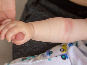 Eccema en bebés: ¿el estrés de las madres durante el