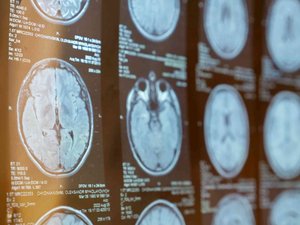 Esclerosis múltiple: ¿por qué nuestro sistema inmunológico se vuelve en