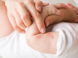 Eccema en bebés: avance de investigadores de Toulouse