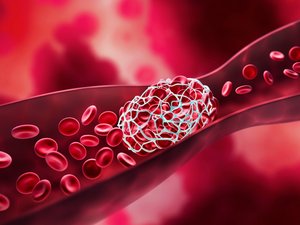 Enfermedad tromboembólica venosa: ¿podremos prevenir el riesgo de recurrencia?