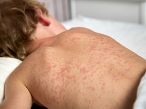 « Es diez veces más transmisible que la gripe»: el