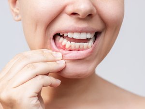 Salud bucodental: ¿por qué es importante cuidar de las encías?