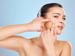 ¿Por qué no deberías exprimir tus puntos negros?