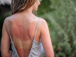 Quemadura solar: ¿cuándo consultar?