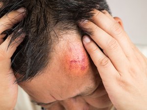 Después de un golpe, ¿de dónde viene este bulto?