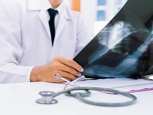 Cáncer de pulmón en no fumadores: la contaminación como culpable