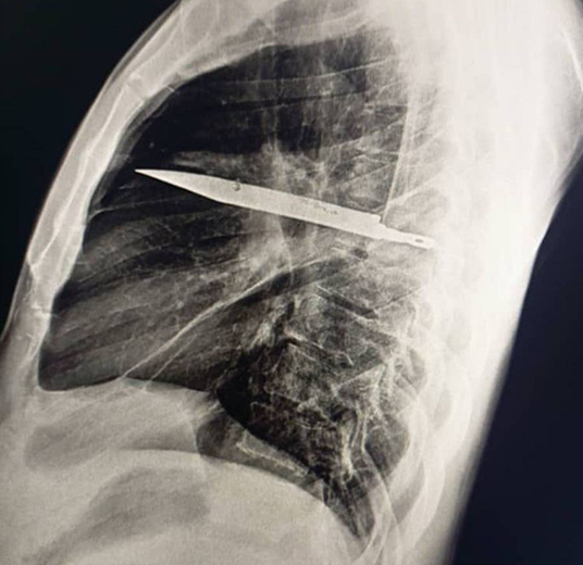 Desde hace 8 años, vivía con una hoja de cuchillo