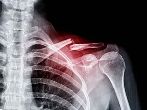 Fractura: un adhesivo para reparar los huesos en unos minutos.