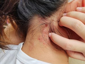 Psoriasis: una enfermedad de la piel asociada a varias otras