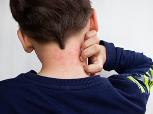 Pénicilline: una alergia confirmada en solo el 10% de los