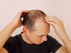 Caída del cabello: ¿pronto un tratamiento efectivo contra la calvicie?