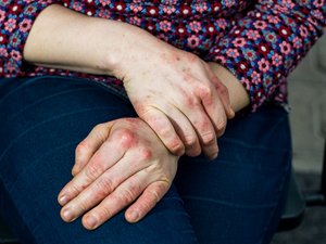 Eccema crónico de manos: una enfermedad que impacta la vida