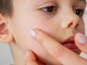 6 consejos para aliviar la piel seca de los niños