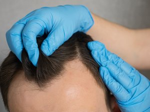 Implante de cabello: ¿cuáles son los riesgos?