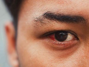 ¿Qué es una hemorragia subconjuntival?