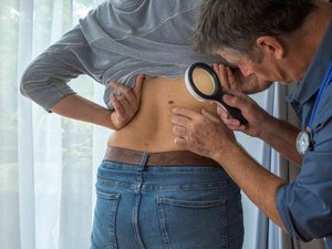 Cáncer de piel: más frecuente pero mejor tratado, el doble